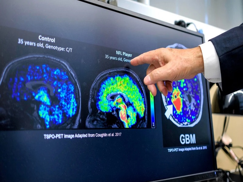 Gran descubrimiento: Científicos latinos en EE.UU. hallan biomarcador que podría detectar temprano el Alzheimer